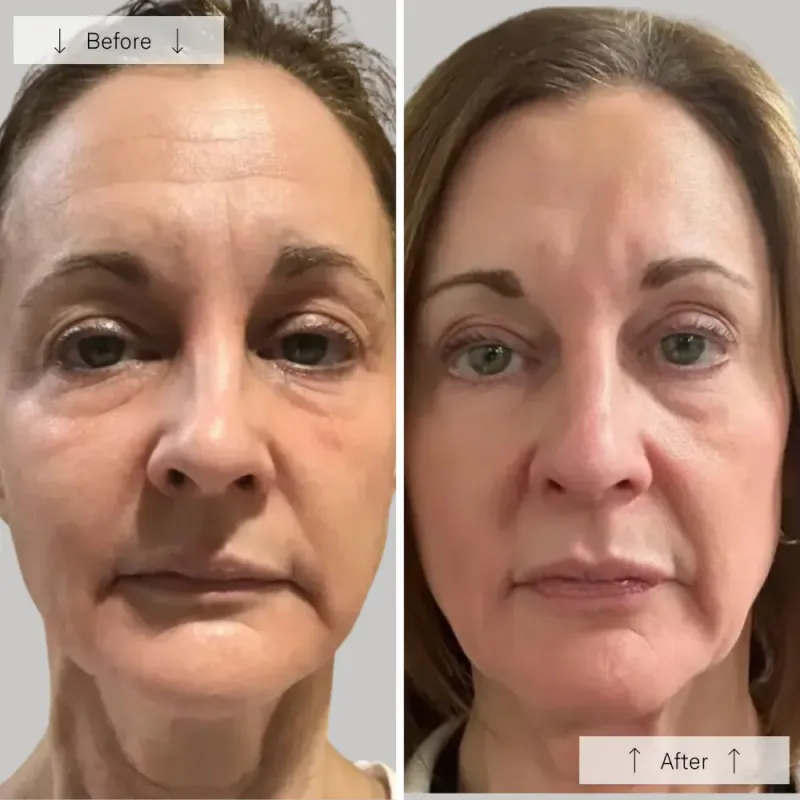 OMNILUX CONTOUR for aldring og inflammasjon